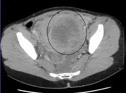 A very large (9&nbsp;cm) fibroid of the uterus which is causing pelvic congestion syndrome as seen on CT