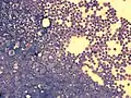 Bone marrow smear from a person with ALL