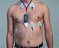 A 5-lead placement EASI configuration Holter monitor