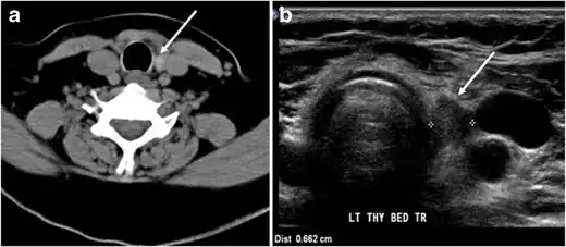 Fig. 7. A 51-year-old female patient post total thyroidectomy for PTC with elevated thyroglobulin measurement. an Axial non-enhanced CT scan of the neck at the level of the thyroid bed demonstrates a well-defined, rounded, homogenously dense soft tissue situated between the trachea and left internal jugular vein (white arrow). b Transverse ultrasound image of the neck demonstrates a well-defined, homogeneous, hypoechoic soft tissue nodule measuring 6&nbsp;mm (white arrow) with no detected micro-calcifications. Biopsy showed a predominantly residual normal thyroid tissue with micro-foci of PTC.[1]