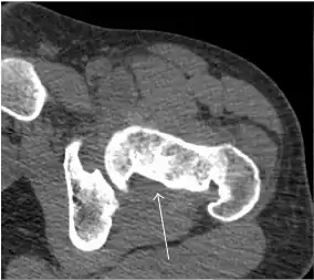 Axial CT image of pigmented villonodular synovitis eroding the posterior cortex of the femoral neck.[1]