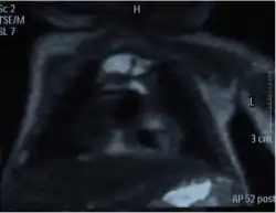 Chest MRI showing a hemothorax in a 16-day-old infant
