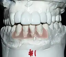 Sometimes the final position and restoration of the teeth will be simulated on plaster models to help determine the number and position of implants needed.