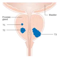 Diagram of a prostate showing a small (T1), medium (T2), and large (T3) tumor