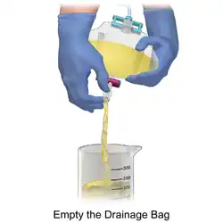 How to empty the urinary drainage bag Illustration.