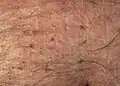 Pubic lice on the abdomen