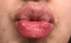 Close-up of lips with fordyce spots