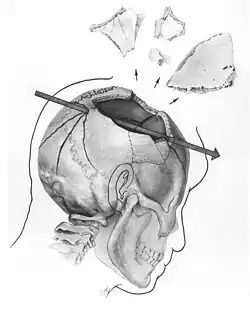 Trajectory of the missile through President Kennedy's skull. The bullet struck posterior part of his right parietal bone from behind.