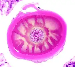 Histology of a multilayered corpus amylaceous of the prostate.