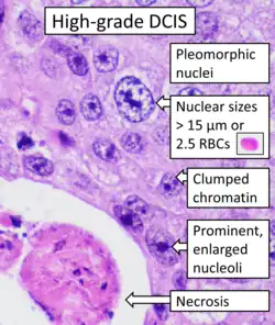Histopathology of high-grade DCIS. H&E stain. RBC = red blood cell.[25]