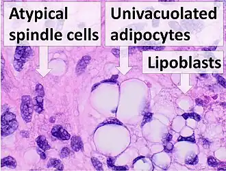 Histopathology of liposarcoma, H&E stain, with the main features:[5] - Spindle cells with enlarged, hyperchromatic nuclei. - Apparently univacuolated adipocytes (may look normal). - Lipoblasts (multivacuolated), but neither necessary nor sufficient for diagnosis of liposarcoma.