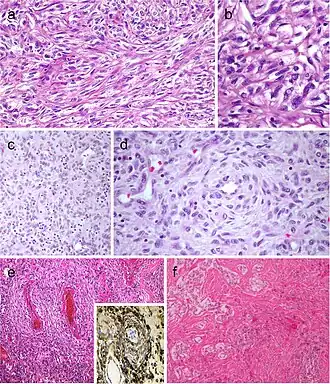Spindle cell variant of papillary thyroid carcinoma (PTC) showing spindle cells with typical PTC nuclei (a and b). Meningioma-like follicular adenoma (c and d), the typical arrangement of spindle to ovoid cells in a whorled pattern may give the impression one is dealing with a vascular tumor. Pericytic-like follicular adenoma (e) is characterized by a proliferation of spindle follicular cells concentrically arranged around vessels; the follicular nature of the tumor cells could be confirmed by the positivity for thyroglobulin (inset), thyroperoxidase, TTF1 and cytokeratins but negativity for calcitonin and CD31. PTC with fibromatosis/fasciitis-like stroma with both stromal and PTC component (f)[9]