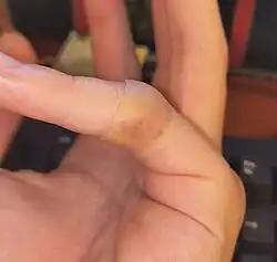 A picture of a hydrocolloid dressing on a finger.