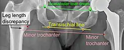 Leg length discrepancy after hip replacement is calculated as the vertical distance between the middle of the minor trochanters, using the acetabular tear drops[95] or the transischial line[16] as references for the horizontal plane. A discrepancy of up to 1&nbsp;cm is generally tolerated.[95][16]
