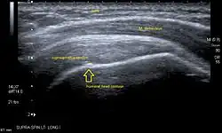 Longitudinal ultra sonography of the supraspinatus tendon