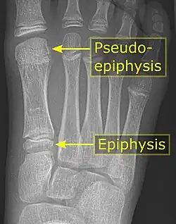 It is common in children to have a pseudo-epiphysis of the first metatarsal.[5]