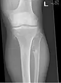 Multiple osteochondromas around the knee
