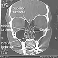 Normal Nose CT Front cross section