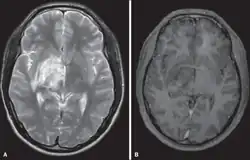 MRI scan of Neuro-Behect brain