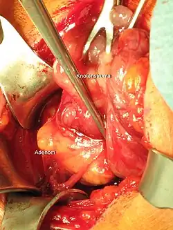 surgical photo of parathyroid gland removal