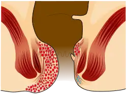 A grade IV hemorrhoid protrudes out of the anus.