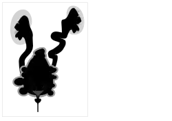 Posterior urethral valves - easily mistaken for cystic renal disease on early scans; appearances are due to obstruction not cysts