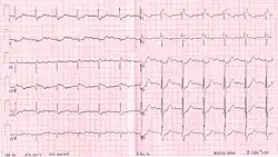 RBBB with associated first degree AV block