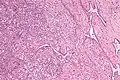 Micrograph of the rete testis involved by seminoma. H&E stain.