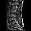 MRI lumbar spine with degeneration, post-hemilaminectomy L4-5 (sagittal T2 FRFSE)