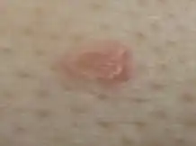 Sebaceous hyperplasia with surrounding chronic folliculitis, right mid chest