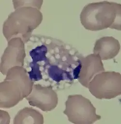 A vacuolated neutrophil