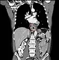 Contrast CT scan showing an esophageal tumor (coronal view)