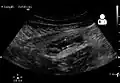 Ultrasound showing appendicitis and an appendicolith.[62]