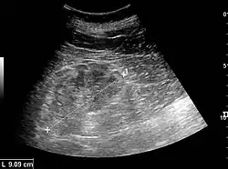 Chronic renal disease caused by glomerulonephritis with increased echogenicity and reduced cortical thickness. Measurement of kidney length on the US image is illustrated by '+' and a dashed line.[63]