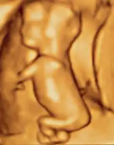 3D ultrasound of 75-millimetre (3.0&nbsp;in) fetus (about 14 weeks gestational age)