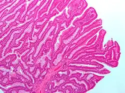 Micrograph of a villous adenoma. These polyps are considered to have a high risk of malignant transformation. H&E stain.