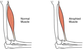 Schematische vergelijking tussen gezonde spier (links) en dezelfde spier getroffen door atrofie (rechts).