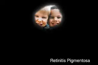 Kokervisus veroorzaakt door retinitis pigmentosa