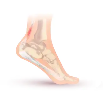 Achillespeesontsteking