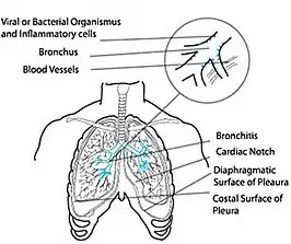 Bronchitis