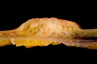 Adenocarcinoom van het colon sigmoides