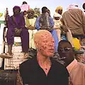 Albino uit Nigeria