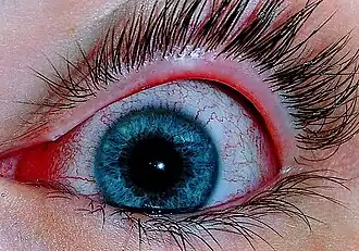 Virale bindvliesontsteking