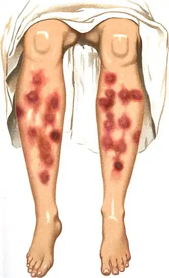 Erythema nodosum