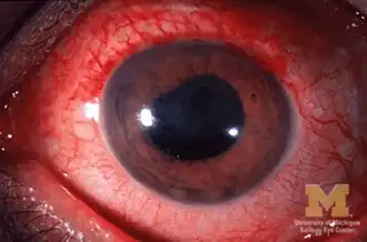 Uveïtis in de voorzijde van het oog (anterior)