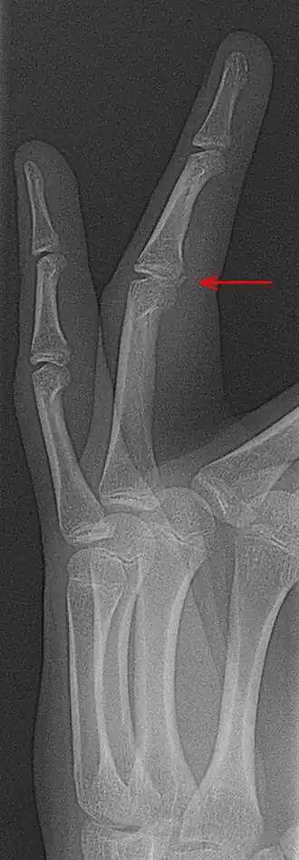 Avulsiefractuur aan de ventrale zijde (aan de kant van de handpalm) van een vinger.