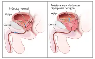 Benigne prostaathyperplasie