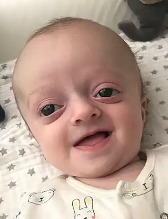 Baby met het Crouzon-syndroom