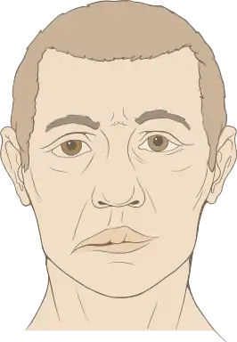 Diagram van een gezicht met Bellse parese.