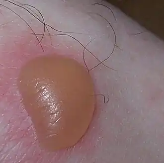 Een blaar na een verbranding